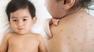 শিশুদের হাম প্রতিকারে যা জানা জরুরি