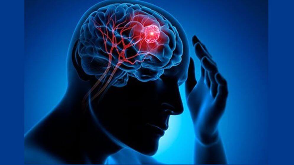 মস্তিষ্কের টিউমারের ৭টি সতর্ক সংকেত: ভুলেও এড়িয়ে যাবেন না