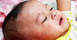 গত ২৪ ঘন্টায় হামের উপসর্গে আরও ৪ মৃত্যু