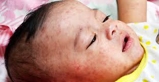 গত ২৪ ঘন্টায় হামের উপসর্গে আরও ৪ মৃত্যু